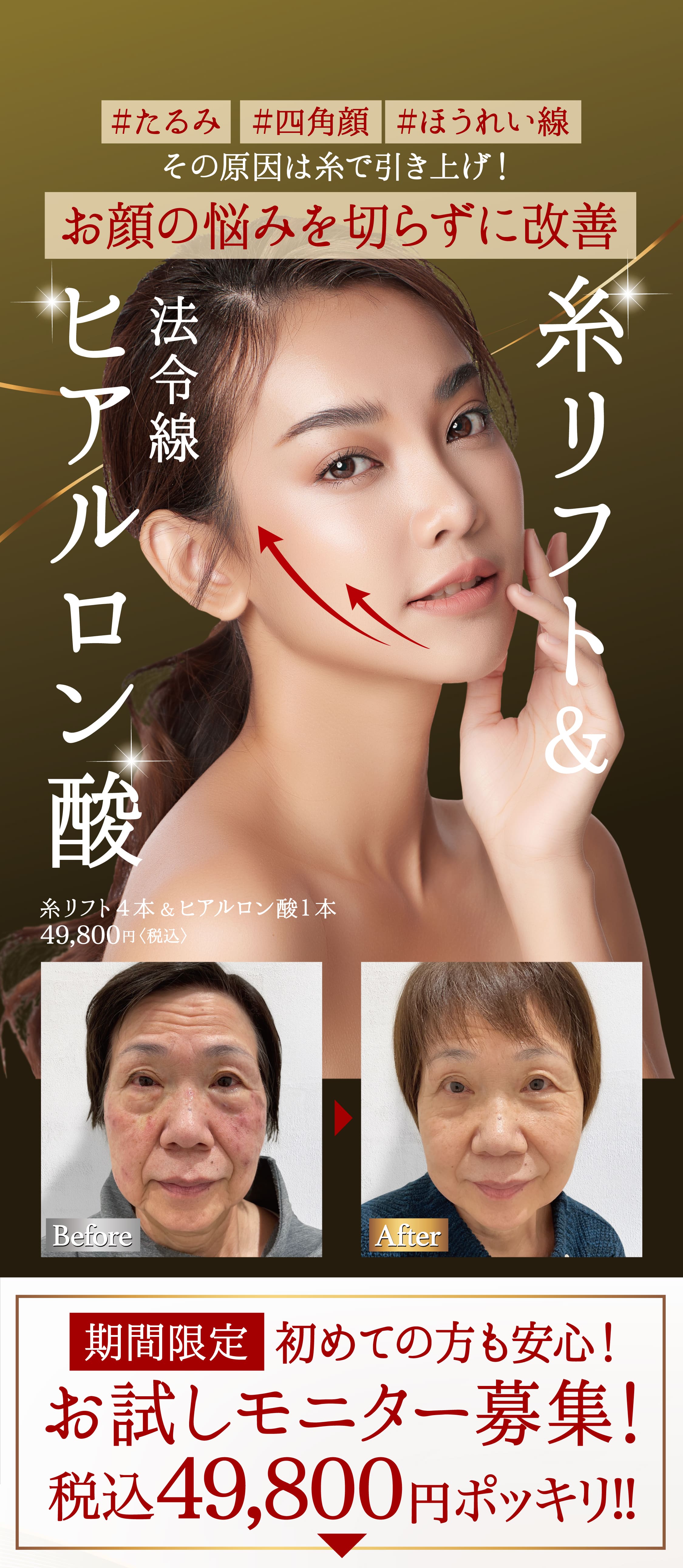 お肌の悩み切らずに改善。糸リフト&豊麗線ヒアルロン酸