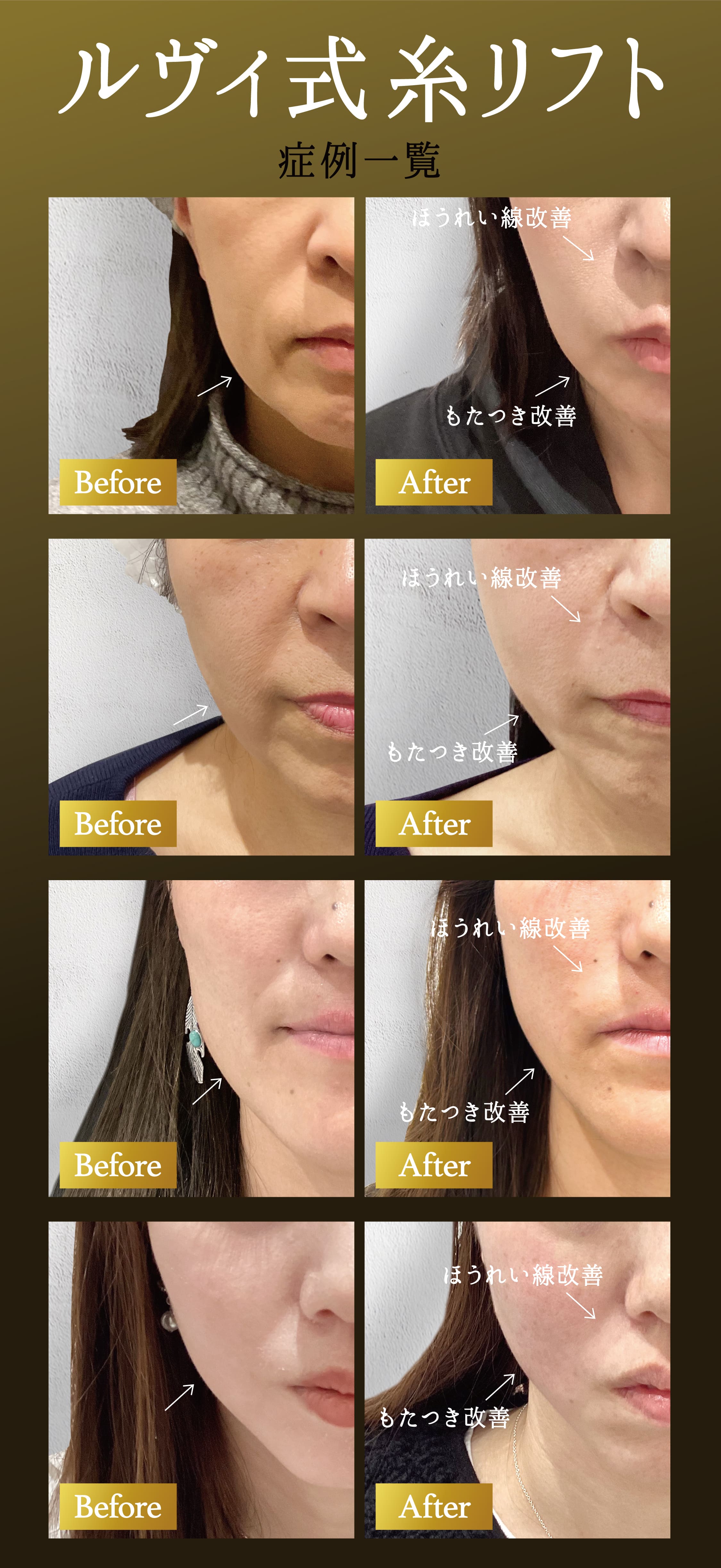 ルヴィ式糸リフト。症例一覧