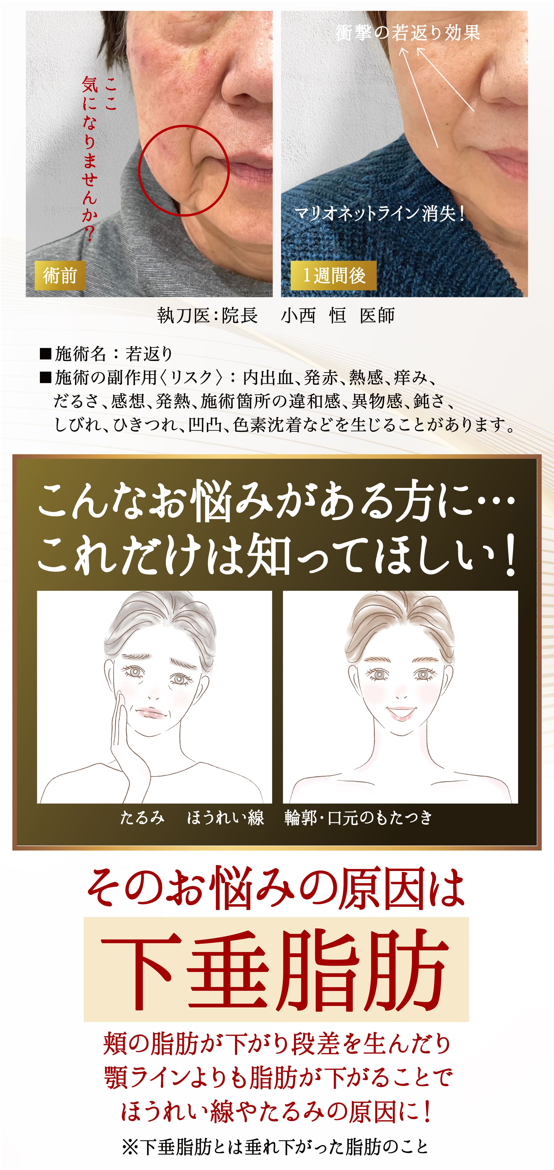 たるみ、ほうれい線、輪郭・口元のもたつき。こんなお悩みがある方に…これだけは知ってほしい！