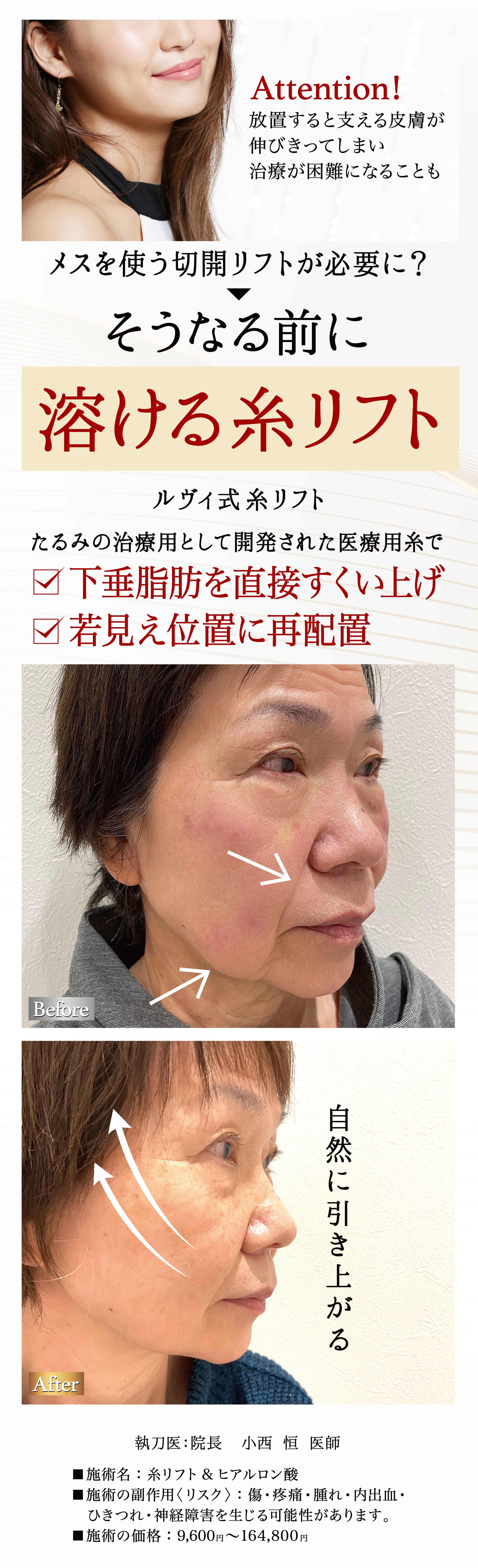 メスを使う切開リフトが必要に？そうなる前に溶ける糸リフト